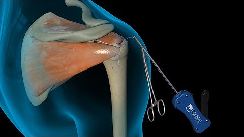 ConMed: Linvatec Rotator Cuff Shoulder Surgery