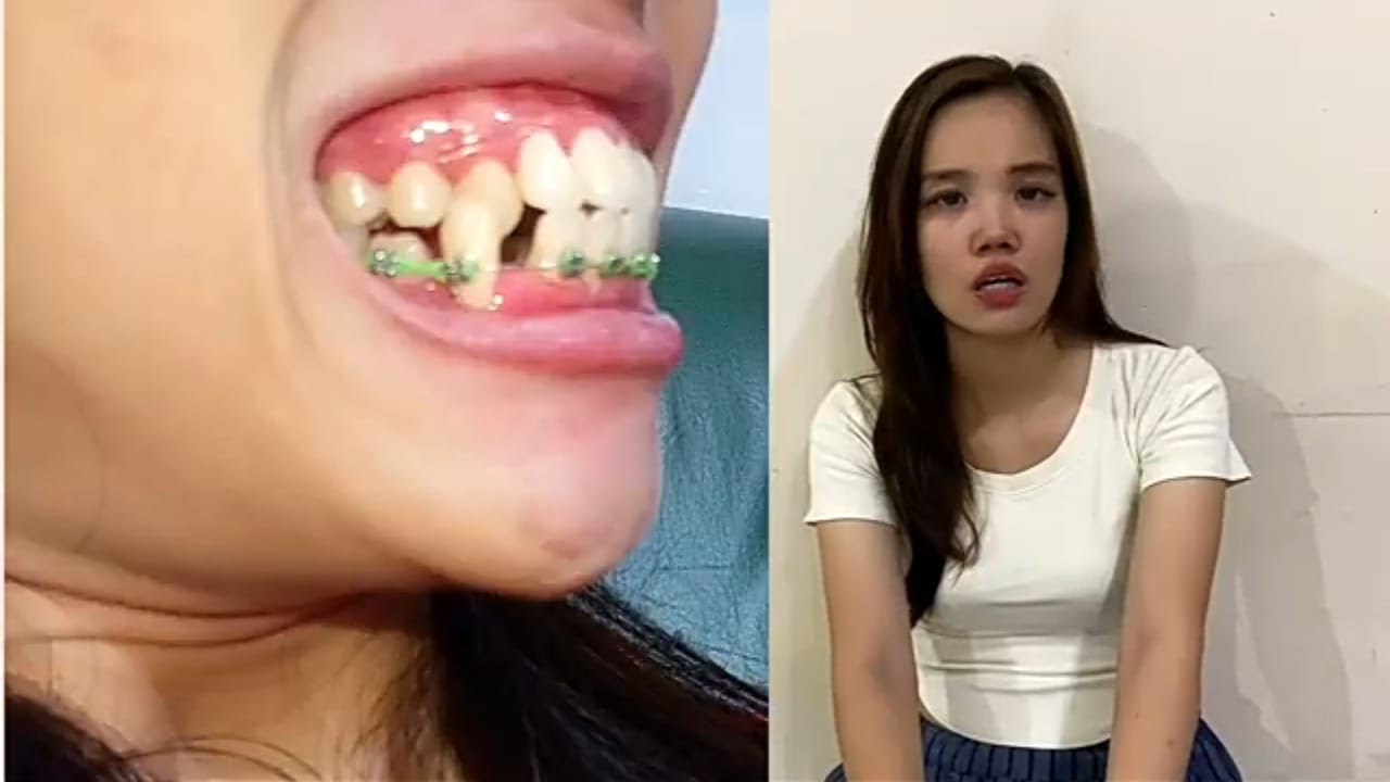 PROSES BEHEL GIGI GINGSUL TONGGOS. 2x BEHEL DRG UMUM DAN DRG ORTHODONTIST