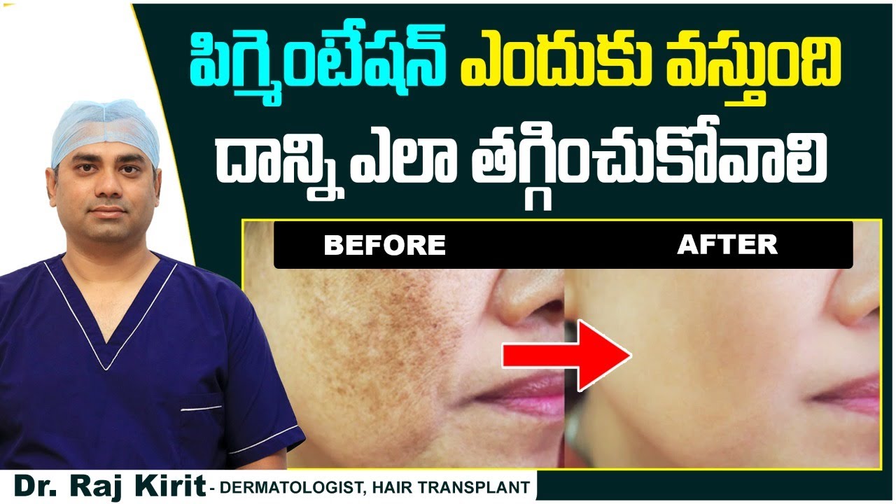 causes-of-pigmentation-in-telugu-pigmentation-on-face-celestee
