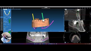 10.0: Acteon Walkthrough Videos -  "Implant Planning"