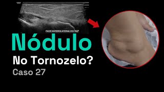 Ultrassom de Tornozelo: Nódulo Com ou Sem Cápsula? | Caso 027 - MSKD
