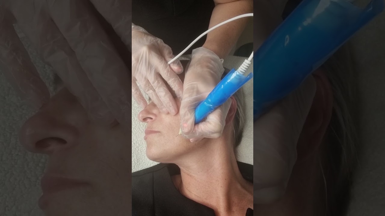 Plasmalift non surgical lifting treatment for the lower face.