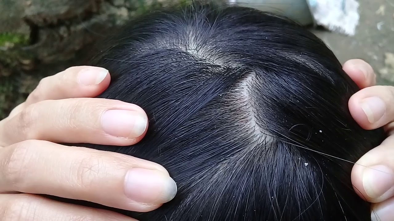 Unplug the itching white hair on the head YouTube