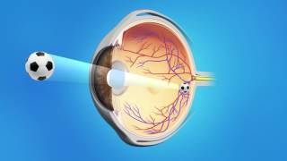Cataract Surgery with a Monofocal Lens