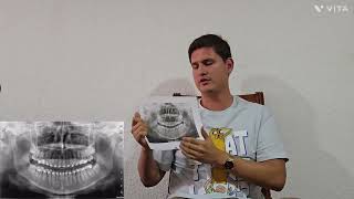 Reflexología: Microsistemas+meridianos. Medicina Alternativa