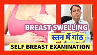 BREAST SWELLING - FIBROADENOMA - स्तन में गठान होना 