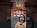 牙齒要左右對稱，有比牙齒中線更重要的兩要件#牙齒矯正#牙套