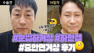 하안검+중안면거상+눈썹하거상으로 다시 찾은 자신감! 50대 남자성형 VLOG😎