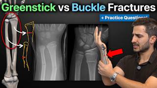 Greenstick and Buckle (Torus) Fractures: Explained! + Practice Qs | Everything You Need to Know