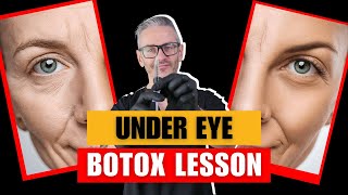 Should you inject Botox under the eye? Under eye Botox Lesson