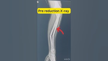 Both bone forearm fracture #fracture
