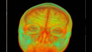 MRI Scan
