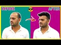 Non-surgical Hair Transplant| Hair replacement for men