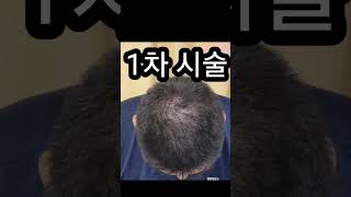 포항 아트킴 두피문신 1차시술