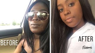 HOW I FINALLY CLEARED MY SKIN ✨ | MY HORMONAL ACNE JOURNEY + ACCUTANE