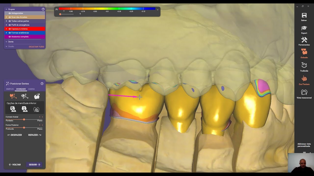 Novidades Exocad DentalCAD 3.0 Galway