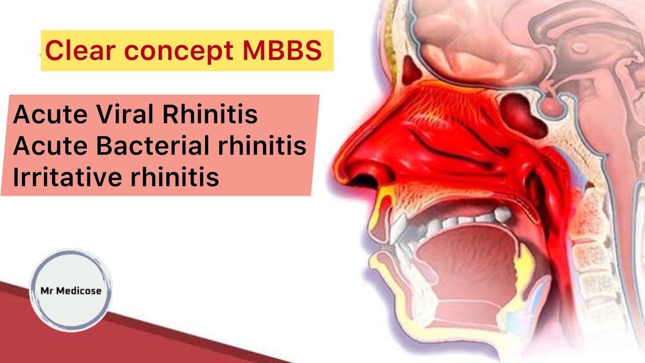 Acute Viral Rhinitis | Acute Bacterial rhinitis | Irritative rhinitis ...