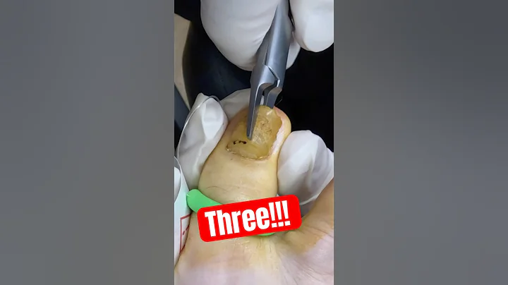 Fungus Toenail Treatment 😳
