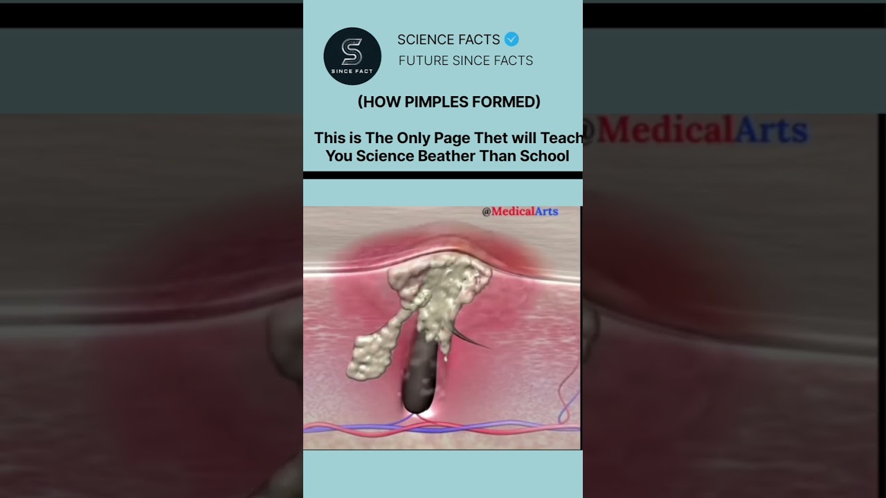 How 🤔 pmples formed biology 🧑‍⚕️ 