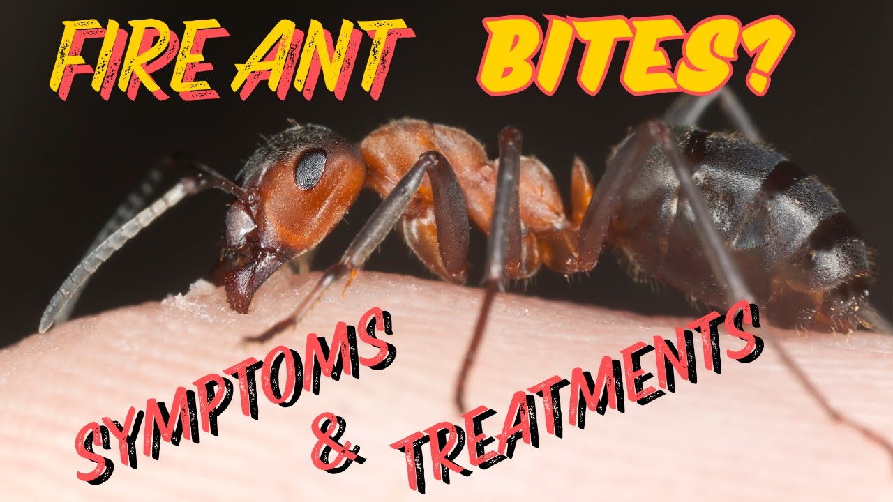 Fire Ant Bites - Symptoms and Treatments - YouTube
