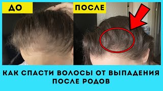 КАК Я СПАСАЮ СВОИ ВОЛОСЫ ОТ ВЫПАДЕНИЯ ПОСЛЕ БЕРЕМЕННОСТИ