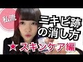 私流!ニキビ跡の消し方-スキンケア編-