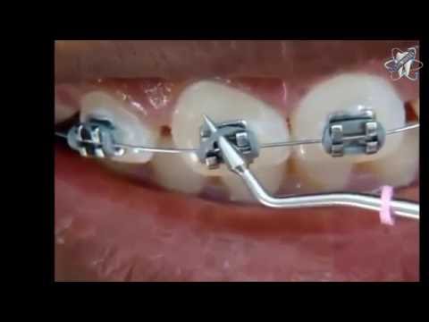 الوان تقويم الاسنان Braces Colors Youtube