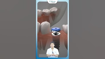 Mất Răng Không Còn Là Nỗi Lo | Nha Khoa Minh Châu