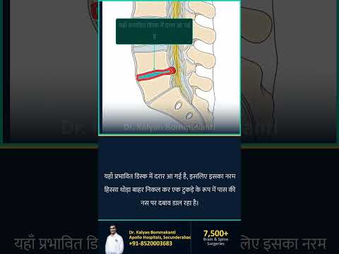 आपकी MRI में स्लिप्ड डिस्क दिखी — क्या आपको सर्जरी की जरूरत है? — बेस्ट एंडोस्कोपिक स्पाइन सर्जन, है