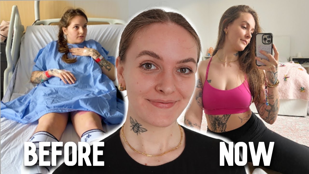 This Surgery Saved My Life // 18 Months Post Hip Replacement UPDATE