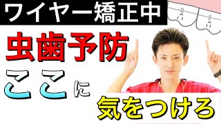 【ワイヤー矯正中】虫歯にならないための３つの方法