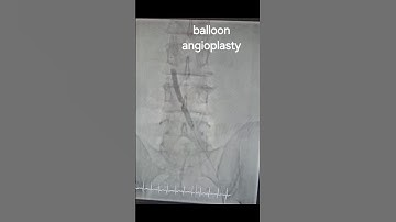 Chronic DVT (Deep Venous Thrombosis) management