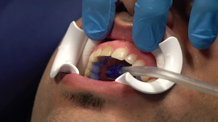 Dr. David Ouellet places Lumineers onDr. Kaveh Koh...