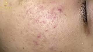 Loan Nguyen Acne Treatment 1738h