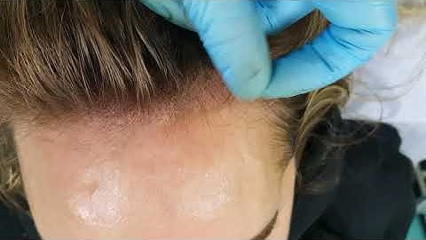 Female Hairline Scalp Micropigmentation Density by El Truchan @ Perfect Definition