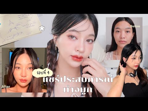 รีวิว & แชร์ประสบการ์แก้จมูกอย่างละเอียด ทำที่ไหน ราคาเท่าไหร่ ตอบหมด! | mildnitha