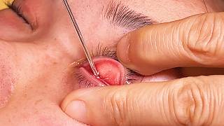 ASMR Meticulous Eye Scraping &amp; Bamboo Steaming (No Talking) 4K (Operate safely, do not imitate)