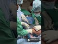 All inside ACL Reconstruction #aclreconstruction #allinsideaclreconstruction #aclsurgery