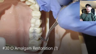 O Amalgam Restoration 1