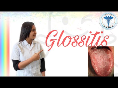 Video: Wat Is Glossitis? Typen, Oorzaken En Symptomen