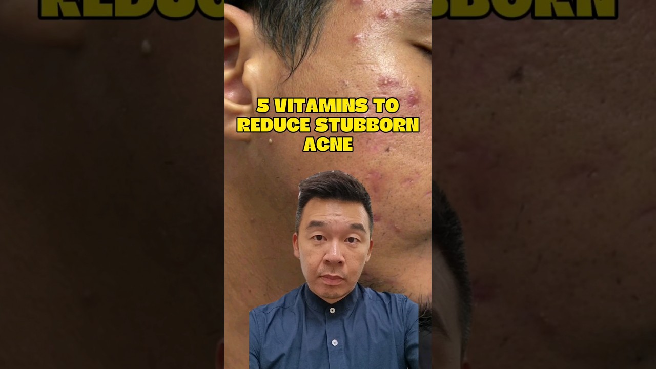 5 vitamins to fight stubborn acne. Sometimes, your skincare needs help!