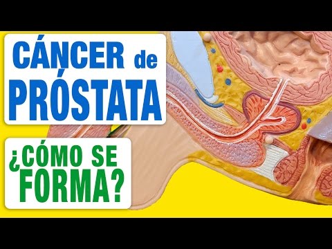 metodos para diagnosticar cancer de prostata metodos para diagnosticar cancer de prostata