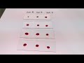 Blood typingrh positive slide agglutination test medical laboratory science