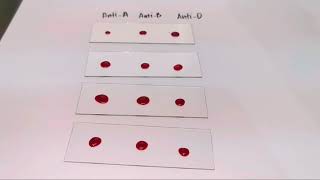 Blood typing(Rh positive) slide agglutination test |MEDICAL LABORATORY SCIENCE screenshot 5