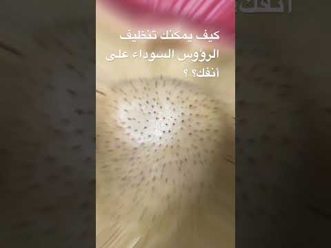 كيف يمكنك تنظيف الرؤوس السوداء على أنفك Kinseibeauty تنظيف البشرة Beauty صالون Hydrafacial
