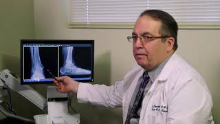 Ankle Arthritis by Dr. Christensen