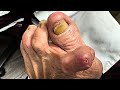 Ulcer debridement and extreme nail cutting on a 94yearold patients deformed toe