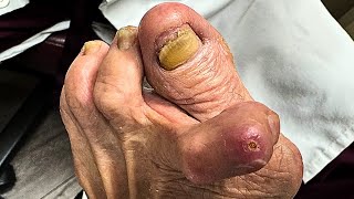 Ulcer Debridement and Extreme Nail Cutting On a 94-Year-Old Patient's Deformed Toe!