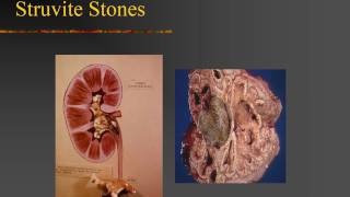 KidneyStoneCauseEvalPrevention
