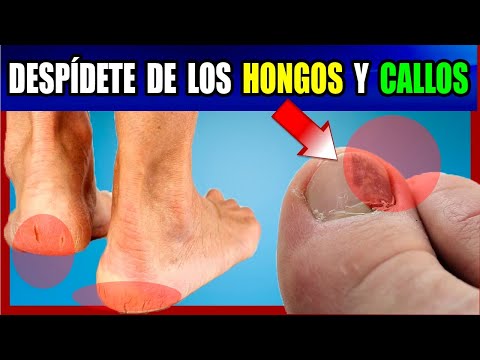 Que es bueno para los hongos de los pies